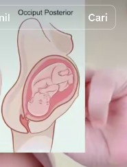 Kasus Occiput posterior