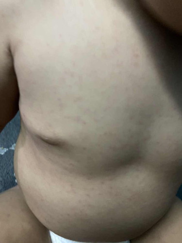 Hi semua. Nk tanya ada sesiapa anak pernah kena begini? Bintik2 merah hampir 1 badan. Baby 1 tahun.