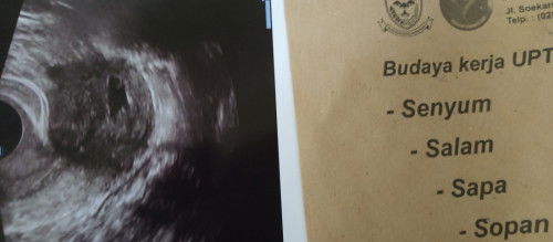 Hamil LG setelah keguguran