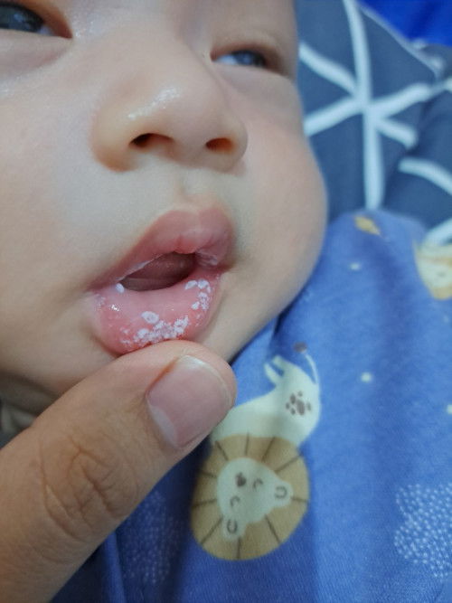 Putih putih dimulut bayi