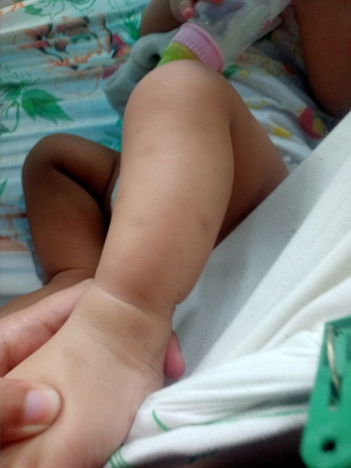 Dark Spots from Mosquito Bites.