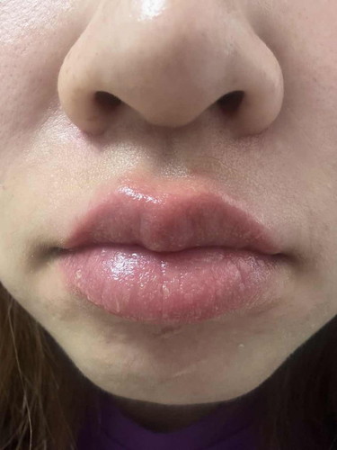 ปากแห้งแดง มีอาการแสบคัน เกิดจากอะไรค่ะ