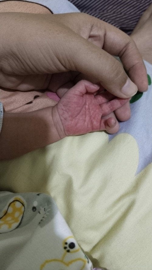 Bintik merah pada kaki dan tangan bayi