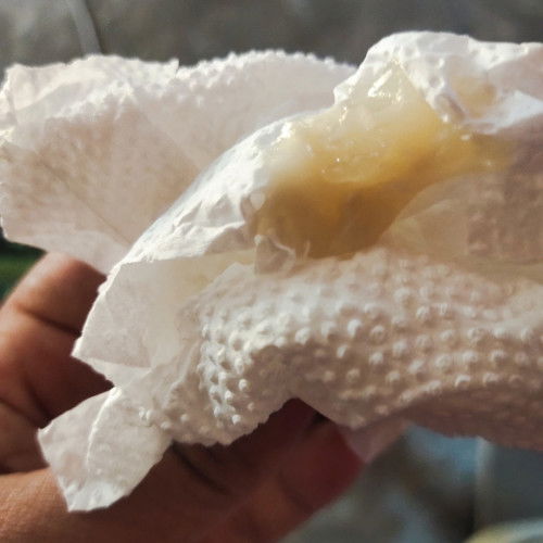 อายุครรภ์38สัปดาห์แล้วมีของไหลออกจากช่องคลอดแบบนี้ปกติไหมคะ