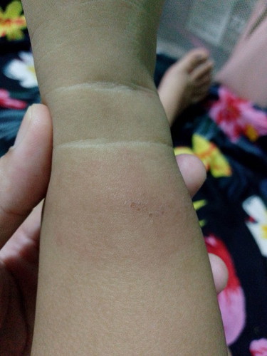Ano Pong cream pede sa 1 yr old may umbok na rushes tapos may nalabas na onting water