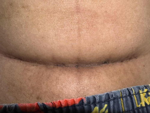 แผลผ่าคลอด ผ่าคลอดมาแล้ว 1 เดือนกว่าๆ สีแบบนี้ปกติไหมคะ