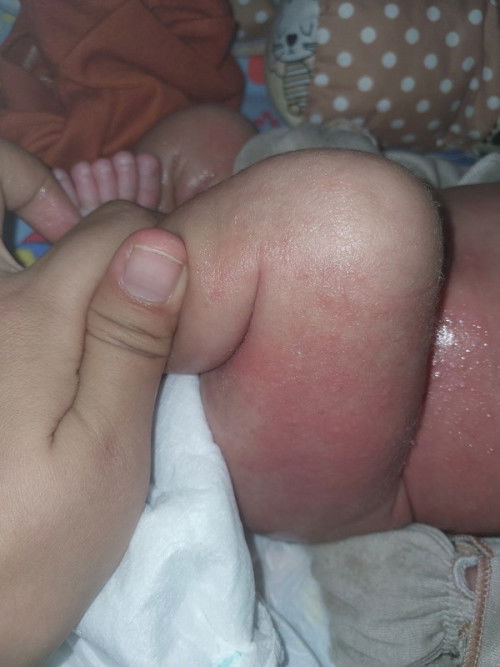 Ruam kulit pada bayi (bintik putih kecil disertai kemerahan)