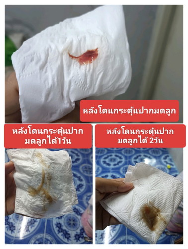 กระตุ้นคลอด 38w+2d