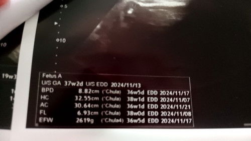 แม่ๆ เชื่อเรื่อง เดินบ่อยๆ จะทำให้คลอดง่ายมั้ยคะ ??