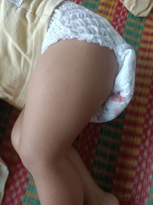 น้องเป็นผื่นอะไรคะแม่ๆ ทำยังไงให้หายคะ