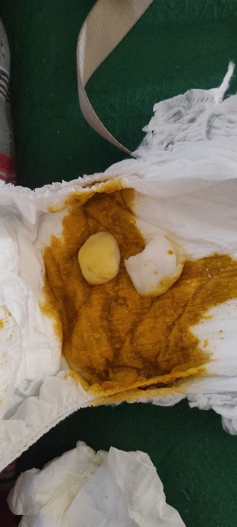 Diare pada anak umur 4 bulan, gimana cara mengatasinya?