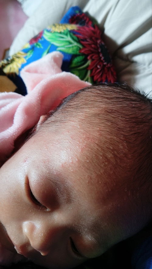 biang keringat atau bukan