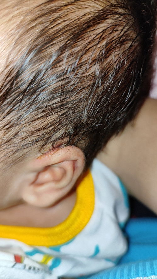 Ano po nilalagay nyo SA tenga NI baby?