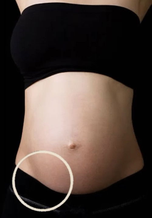 #ปวดท้องด้านขวาล่าง