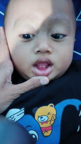 Sariawan pada bayi