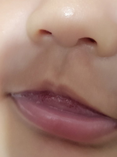 RED SPOT SA TIP NG TONGUE