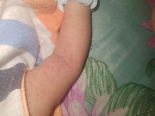 ลูกๆบ้านไหนเป้นเหมือนกันบ้าง?