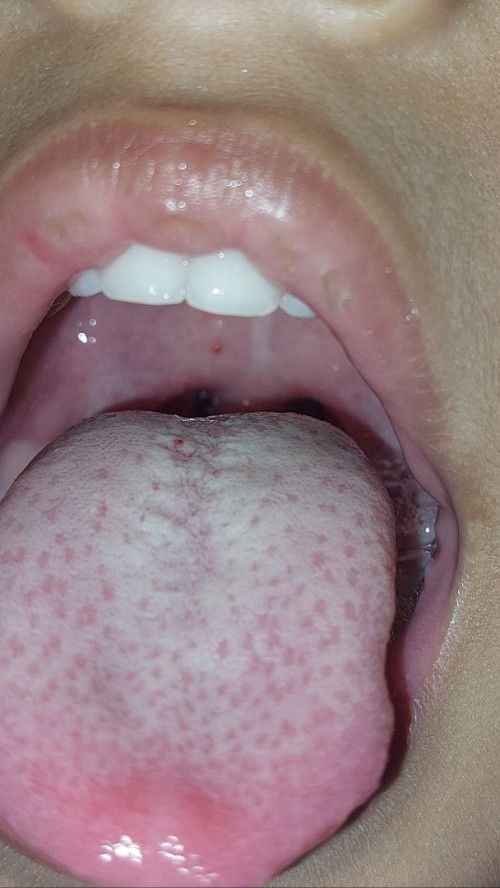 Radang tenggorokan batita