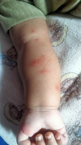 Sore kmrn g ada, pg² udh bgni. Pdhal pke lotion anti nyamuk, ada yg tau itu knp y mam?
