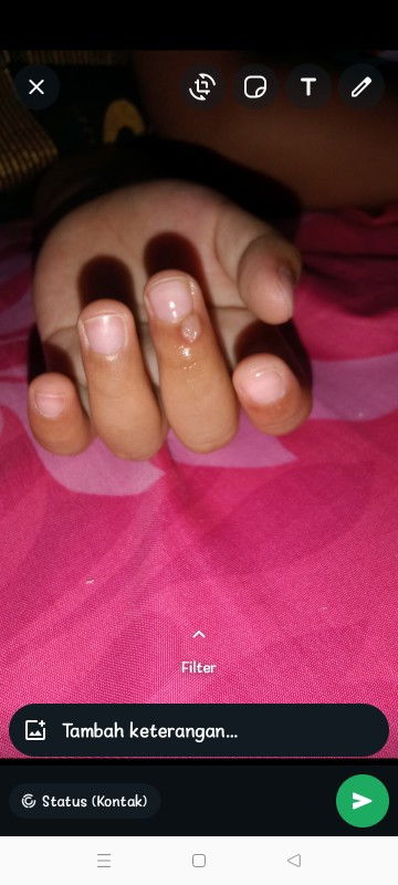 Benjolan kecil di jari