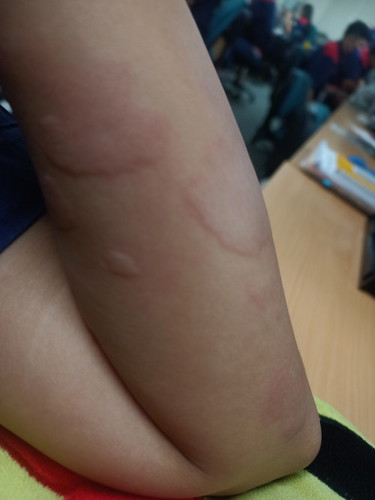 Skin rash/pantal after using depo