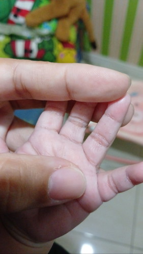 Ibu2 disini ada ga yang tangan anak nya umur 3 bulan kaya gini?ini karena apa ya?awal nya melenting