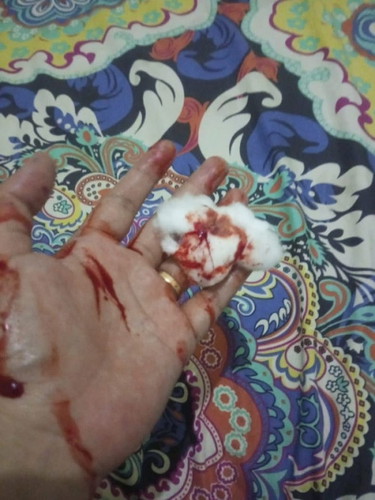 Mau nanya, klo lgi hamil terjadi mimisan knp y bund, malah jdi pusing