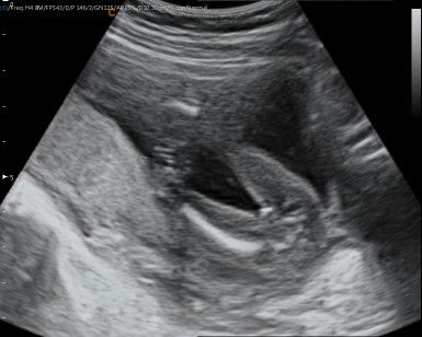 Hasil usg jenis kelamin