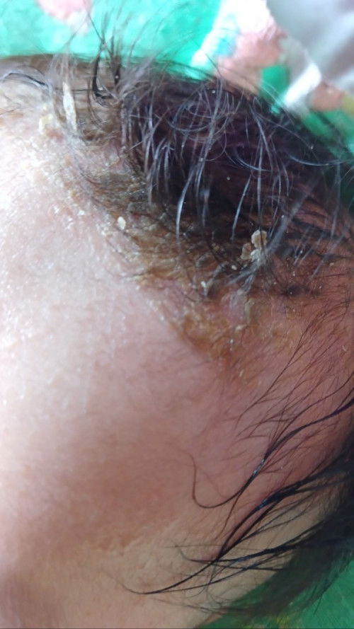 Kerak kepala pada bayi