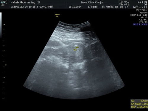 saya sempet USG,ktanya bru 5mg,msh kecil bgt,tapi ko kantungnya tdk terlihat jls kaya yg lain ya?