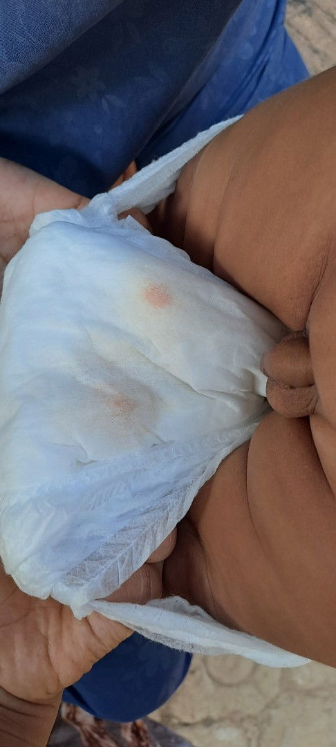 Bayi 5bln pipisnya ada bercak oranye