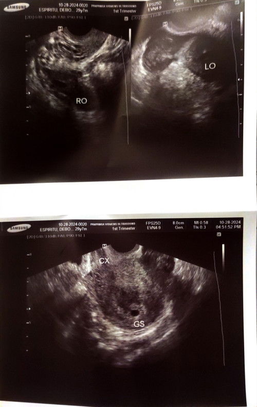 Ultrasound, GS in uterus but there is Blood clot or Ectopic beside my Ovary