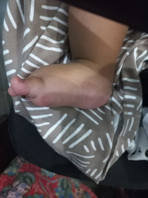 Telapak kaki/punggung kaki gemuk