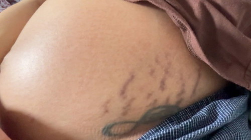 ท้องแตกลายขณะตั้งครรภ์