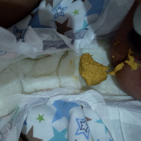 Poop ni baby: Normal lang po ba sa formula fed baby ang isang beses lang po madumi?