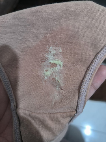 20 weeks Discharge