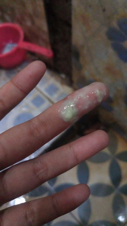 Keputihan di hamil 12 Minggu