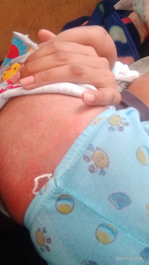 Masalah kulit pada bayi