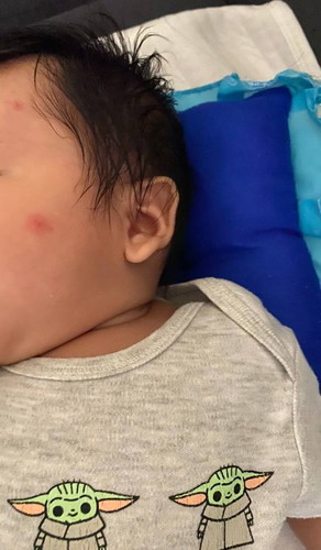 nkagat ng lamok baby ko 2mos old.Ngayon ksi uso dengue.As a ftm diko maiwasan mag alala.kayo dn po b