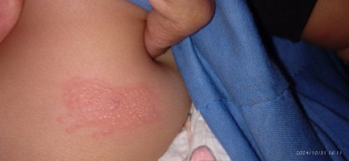 Bentol merah bruntusan