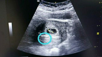 Hamil dengan IUD terpasang