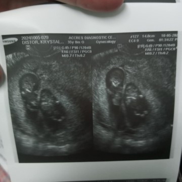 twin baby 15weeks preg