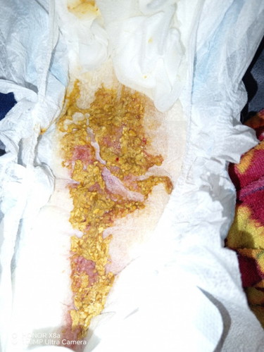 My baby is 5 months old and pooping every after feeding. Her poop is now having blood