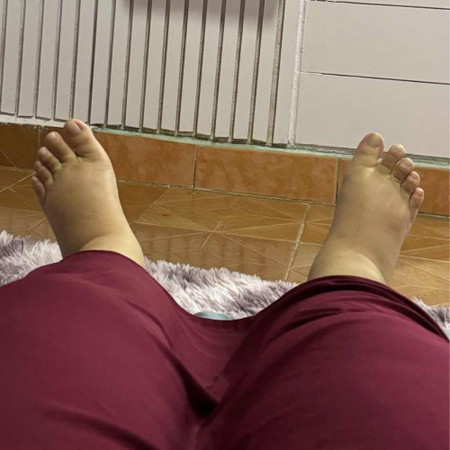 Kaki bengkak teruk