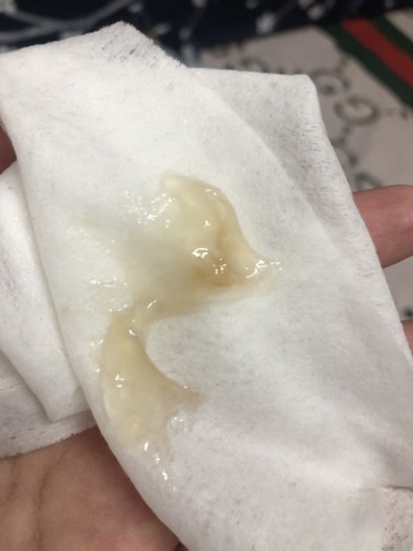 Mucus Plug atau Keputihan?