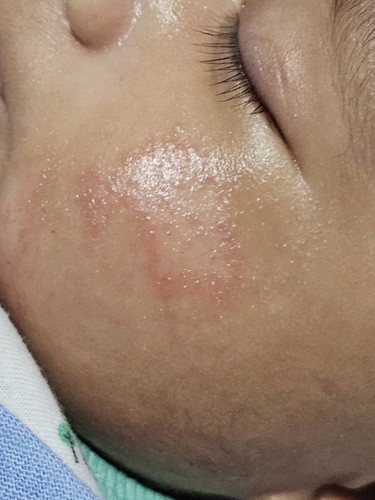 Red patches on cheeks
