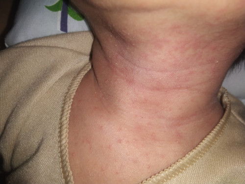 Leher Bayi umur 13 hari merah merah