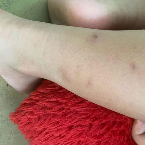 Belas gigitan nyamuk