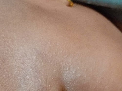 Seperti beruntusan tapi ga merah