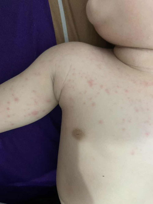 Bintik-bintik dikulit bayi